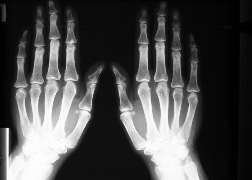 röntgen az ujjak ízületeinek fájdalmának diagnosztizálására